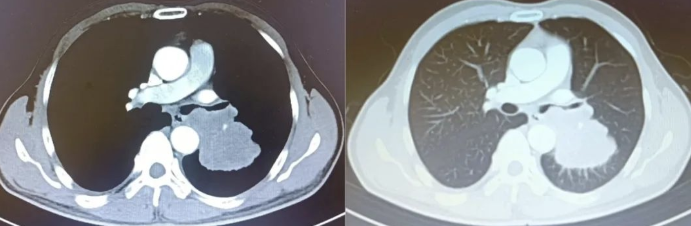 男子咳嗽1个月没在意 一查确诊癌症 医生：太惊险了！(图1)