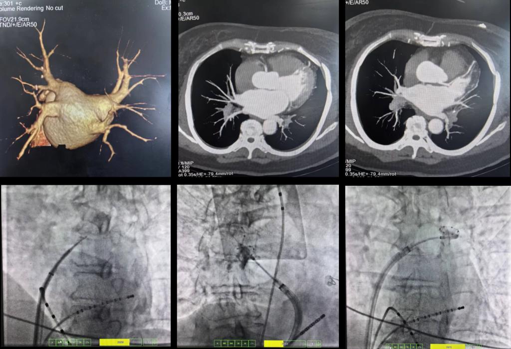 专注精微 以“冻”制动——心内科成功开展首例持续性房颤冷冻球囊导管消融术(图1)